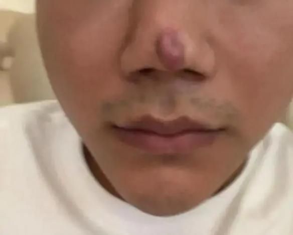 男子整形失败，称颜值不再是吃饭保障 小伙隆鼻后变成“刀疤鼻”(图1)